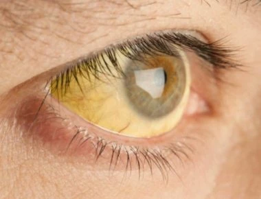 Κίτρινα μάτια: Τι σύμπτωμα είναι- Ποιοι πρέπει να προσέχουν